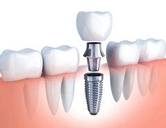 white clay dental|Dental Implants – Newark, DE